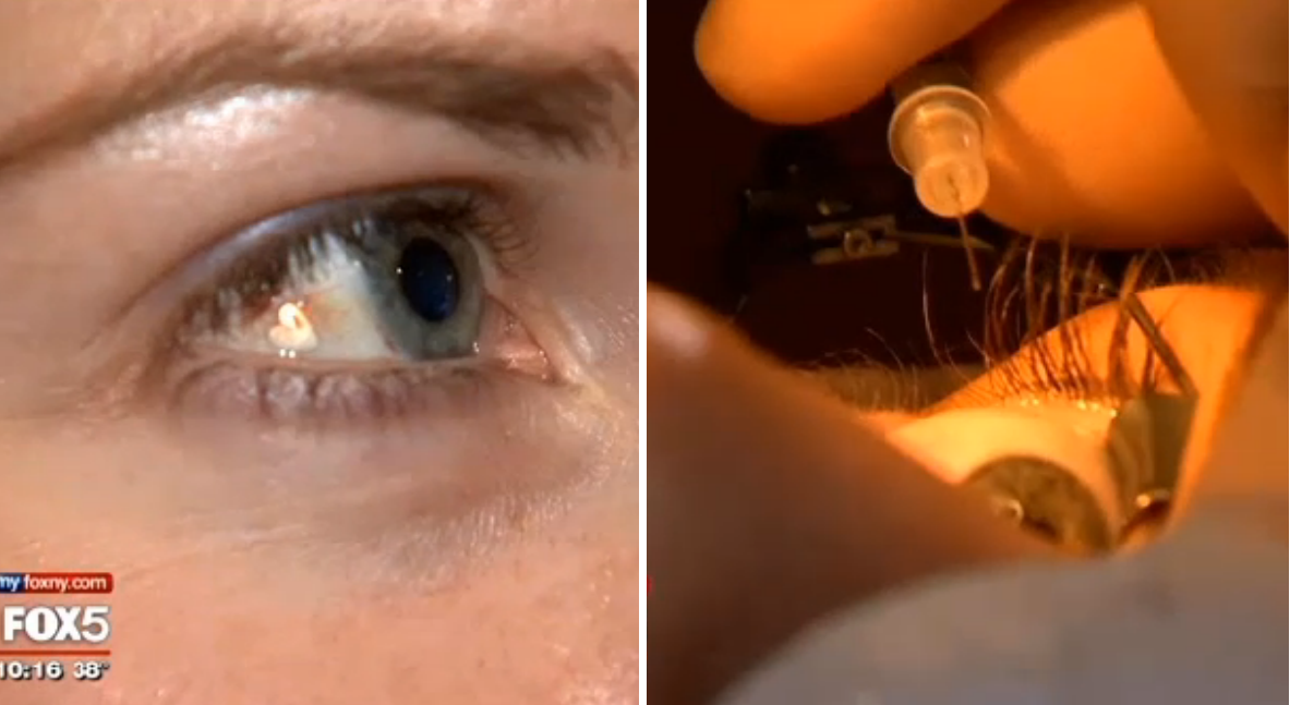 Ögon, Implantat, Snitt, Platina